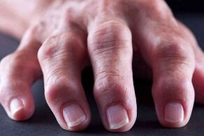 Az ízületi gyulladás és arthrosis fő különbségei