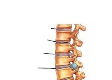 Az osteochondrosis fejlődésének négy szakasza
