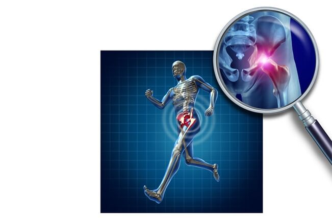 Fájdalom, amikor a csípőízületben fut